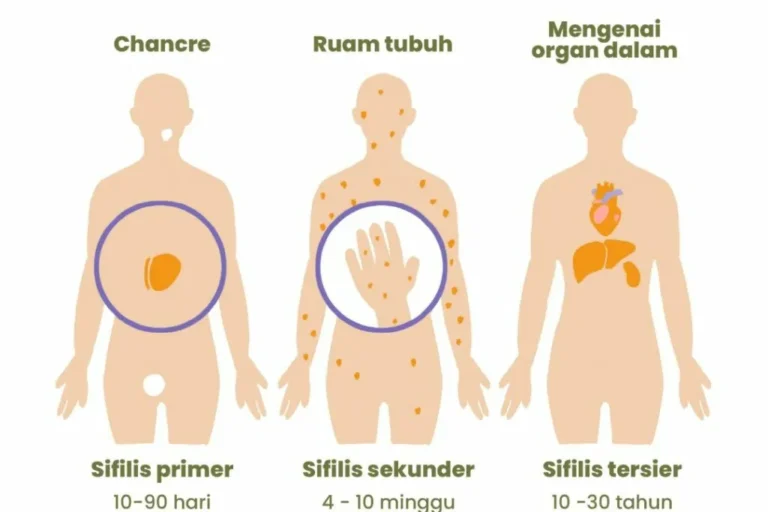 tahapan penyakit sifilis
