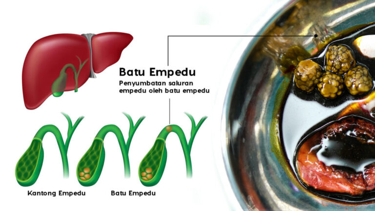 obat batu empedu